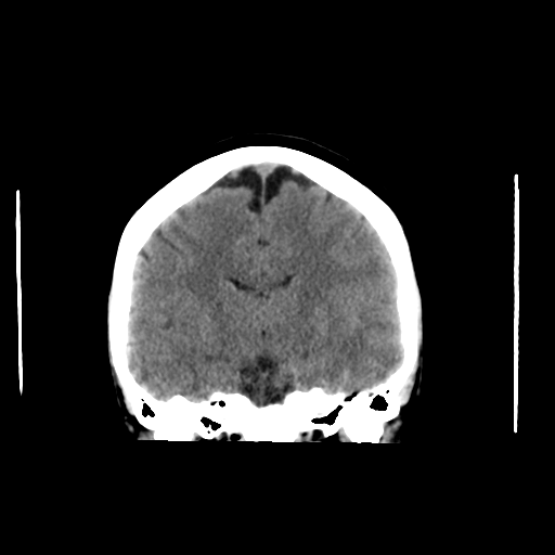 File:Cerebral venous infarction due to transverse sinus thrombosis (Radiopaedia 34688-36116 Axial non-contrast 1).png