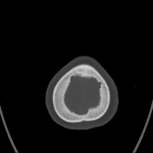 Cerebral venous infarction with hemorrhage (Radiopaedia 65343-74381 Axial bone window 185).jpg