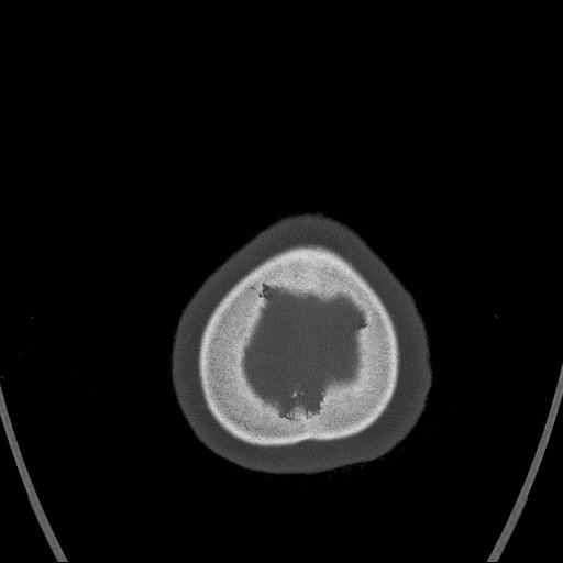Cerebral venous infarction with hemorrhage (Radiopaedia 65343-74381 Axial bone window 187).jpg