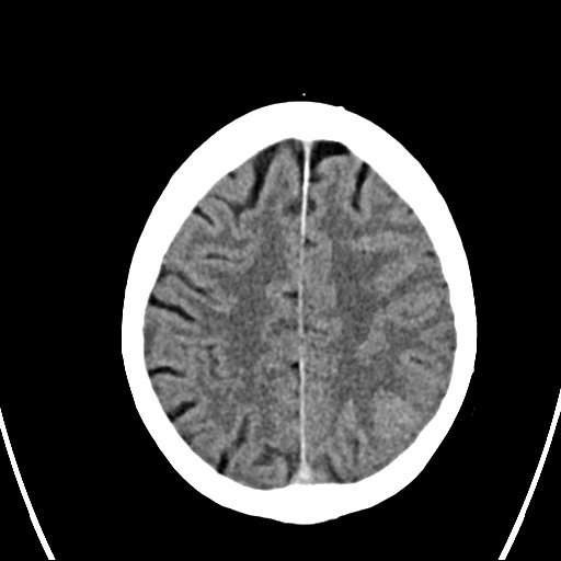 File:Cerebral venous infarction with hemorrhage (Radiopaedia 65343-74381 Axial non-contrast 20).jpg