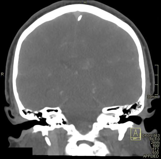Cerebral venous sinus thrombosis (Radiopaedia 91329-108965 Coronal venogram 52).jpg