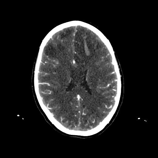 File:Cerebral venous throbmosis - hemorrhagic venous infarction (Radiopaedia 87318-103613 Axial CT venogram 22).jpg