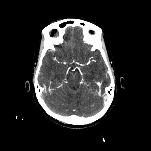 File:Cerebral venous throbmosis - hemorrhagic venous infarction (Radiopaedia 87318-103613 Axial CT venogram 9).jpg