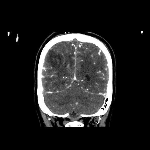 File:Cerebral venous throbmosis - hemorrhagic venous infarction (Radiopaedia 87318-103613 Coronal CT venogram 31).jpg