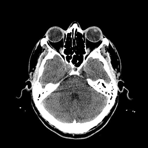File:Cerebral venous thrombosis (CVT) (Radiopaedia 77524-89685 Axial non-contrast 13).jpg