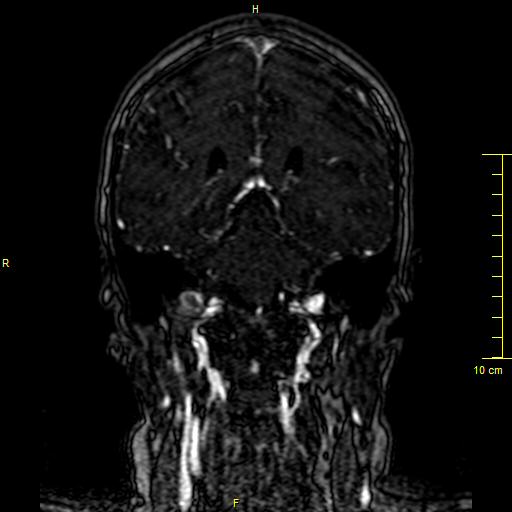 Cerebral venous thrombosis (Radiopaedia 23288-23351 MRV 99).JPG