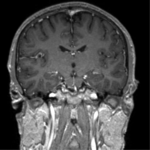 Cerebral venous thrombosis (Radiopaedia 38392-40469 Coronal T1 C+ 44).png