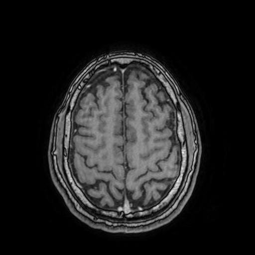 File:Cerebral venous thrombosis with secondary intracranial hypertension (Radiopaedia 89842-106957 Axial T1 C+ 135).jpg