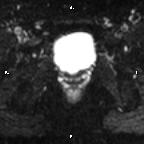 Cervical adenocarcinoma (Radiopaedia 65011-73985 Axial DWI 25).jpg