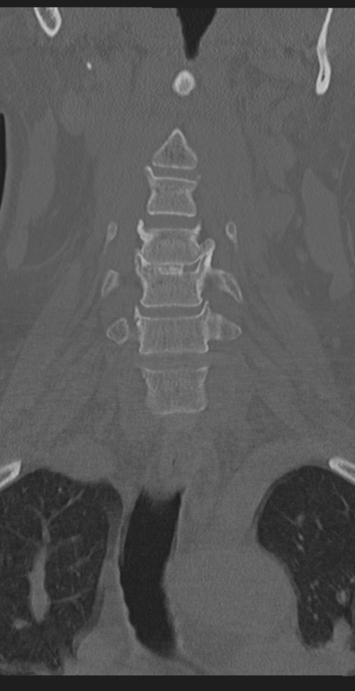 Cervical canal stenosis due to ossification of the posterior longitudinal ligament (Radiopaedia 47260-51823 Coronal bone window 15).png