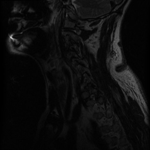 File:Cervical canal stenosis with cord compression (Radiopaedia 34114-35374 Sagittal T2 12).png