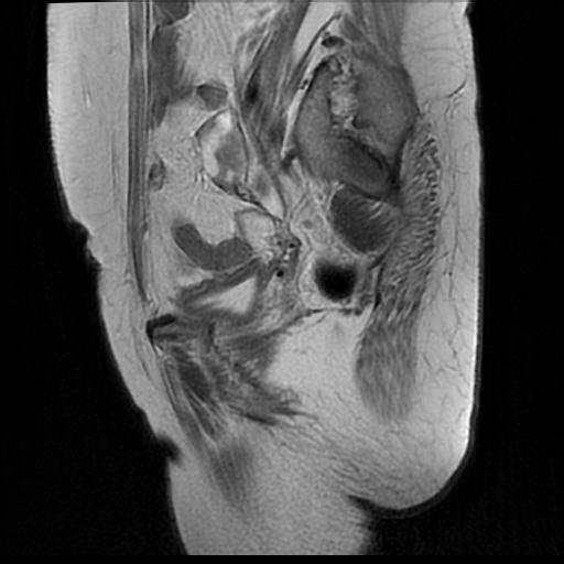 File:Cervical carcinoma (Radiopaedia 88010-104555 Sagittal T2 16).jpg