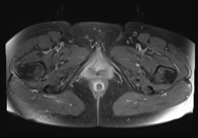 File:Cervical carcinoma (Radiopaedia 88312-104943 Axial T1 C+ fat sat 21).jpg