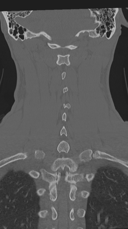 Cervical intercalary bone (Radiopaedia 35211-36748 Coronal bone window 55).png