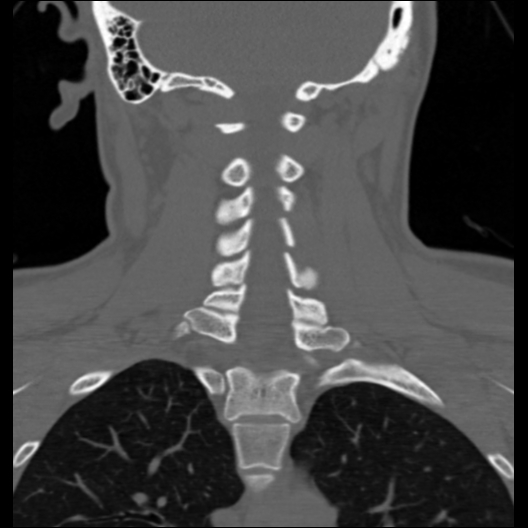 File:Cervical rib (Radiopaedia 71110-81363 Coronal non-contrast 21).jpg