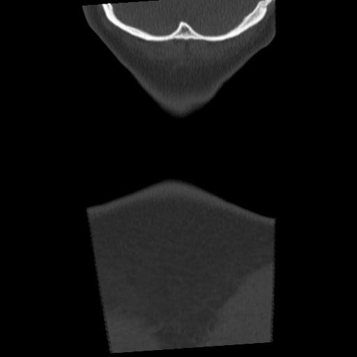 Cervical schwannoma (Radiopaedia 57979-64974 Coronal bone window 63).png