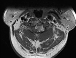 File:Cervical spinal neurofibroma in a patient with NF1 (Radiopaedia 58344-65465 Axial T1 5).jpg