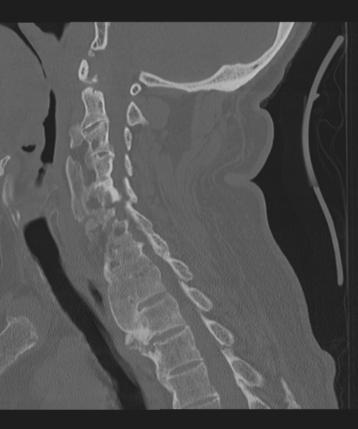 Cervical spine fracture in the setting of ankylosis (Radiopaedia 37038-38715 Sagittal bone window 46).png
