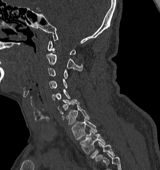 Cervical spine trauma with tear drop fracture and perched facet joint (Radiopaedia 53989-60127 Sagittal bone window 108).jpg
