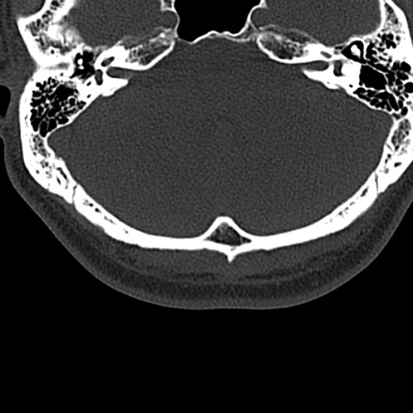 Cervical spondylodiscitis (Radiopaedia 28057-29489 Axial bone window 3).jpg