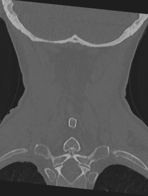 Cervical spondylolysis (Radiopaedia 49616-54811 Coronal bone window 47).png