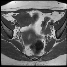 File:Cesarean scar ectopic pregnancy (Radiopaedia 77286-89362 Axial T1 12).jpg