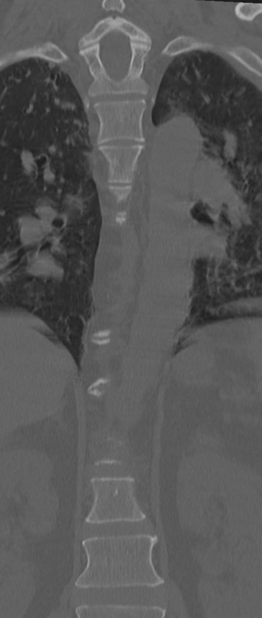Chance fracture (Radiopaedia 33854-35020 Coronal bone window 36).png