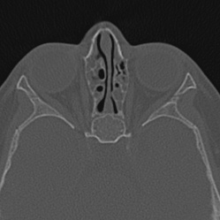 Choanal atresia (Radiopaedia 88525-105975 Axial bone window 75).jpg