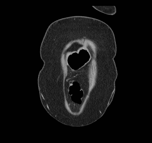 Cholecystoduodenal fistula (Radiopaedia 48959-54022 B 12).jpg