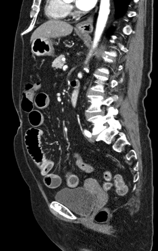 Cholecystoduodenal fistula due to calculous cholecystitis with gallstone migration (Radiopaedia 86875-103077 C 28).jpg