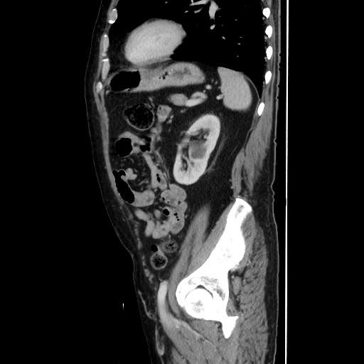 Choledocholiathiasis with normal caliber common bile duct (Radiopaedia 75368-86632 D 114).jpg