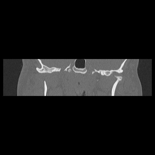 Cholesteatoma (Radiopaedia 84946-100455 Coronal bone window 80).jpg