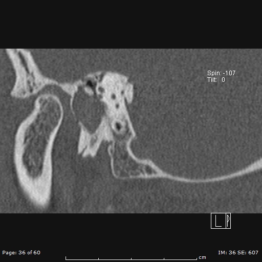 Cholesteatoma - external auditory canal (Radiopaedia 88452-105096 Sagittal bone window 36).jpg