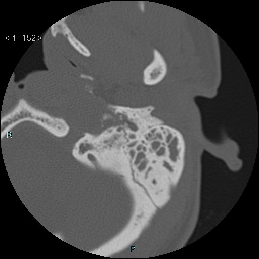 File:Cholesterol granuloma of the petrous apex (Radiopaedia 64358-73141 Axial bone window 73).jpg
