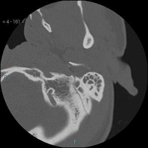 Cholesterol granuloma of the petrous apex (Radiopaedia 64358-73141 Axial bone window 77).jpg