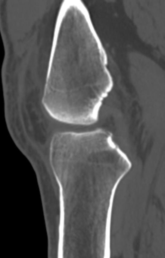 Chondrocalcinosis (Radiopaedia 82862-97173 Sagittal bone window 28).jpg
