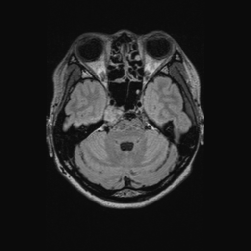 Chondrosarcoma (Radiopaedia 41937-44939 Axial FLAIR 43).png