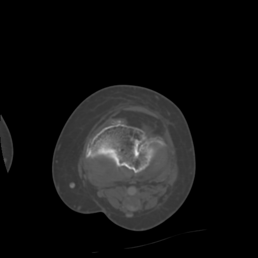 Chondrosarcoma - femur (Radiopaedia 64187-72954 Axial bone window 53).jpg