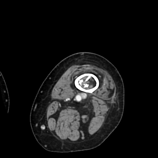 File:Chondrosarcoma - femur (Radiopaedia 64187-72954 Axial with contrast 10).jpg