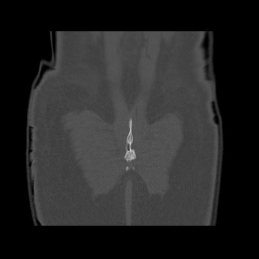 Chondrosarcoma of iliac wing (Radiopaedia 63861-72599 Coronal bone window 106).jpg