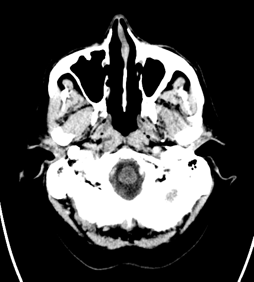 File:Chondrosarcoma of skull base- grade II (Radiopaedia 40948-43653 Axial Contrast 3).png
