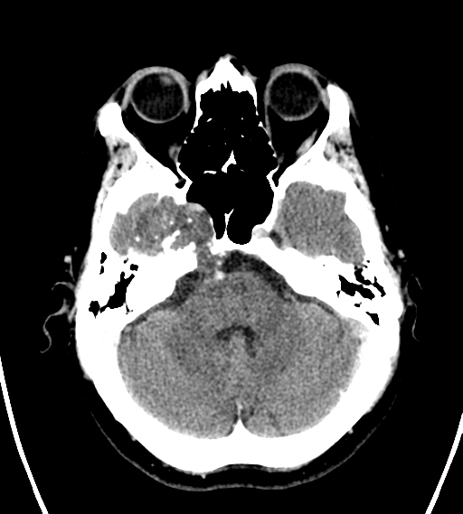 File:Chondrosarcoma of skull base- grade II (Radiopaedia 40948-43653 Axial Contrast 8).png