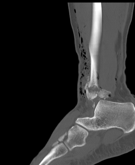 Chopart fracture (Radiopaedia 35347-36851 Sagittal bone window 46).jpg