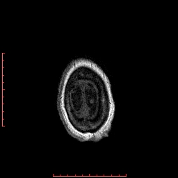 Choroid plexus xanthogranuloma (Radiopaedia 67843-77270 Axial T1 20).jpg