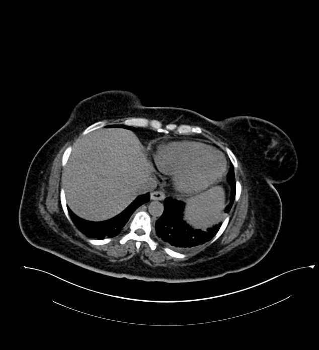 Chromophobe renal cell carcinoma (Radiopaedia 84239-99519 Axial non-contrast 27).jpg