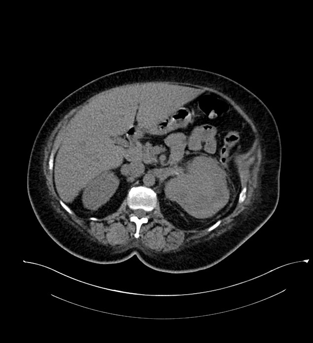 Chromophobe renal cell carcinoma (Radiopaedia 84239-99519 Axial non-contrast 66).jpg