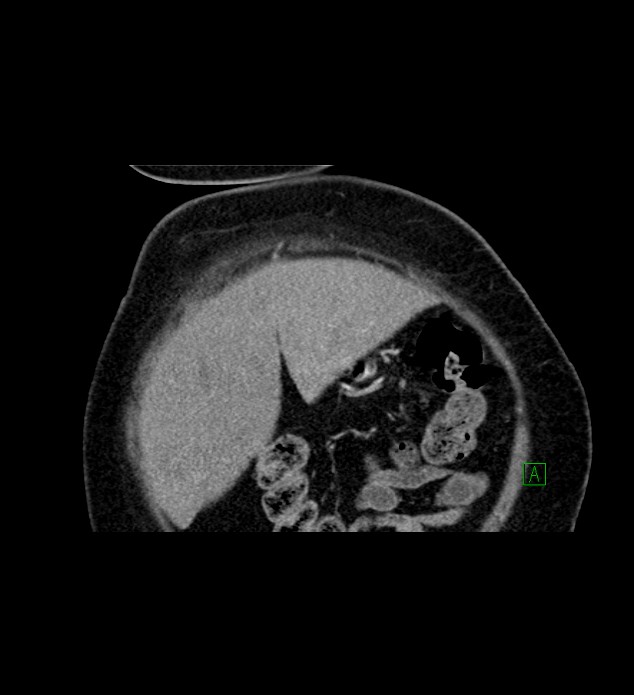 Chromophobe renal cell carcinoma (Radiopaedia 84239-99519 C 15).jpg