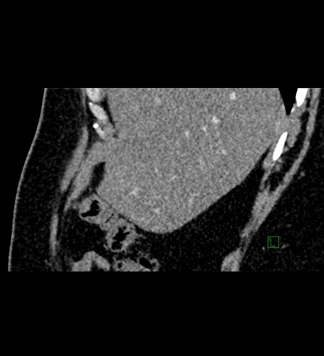 Chromophobe renal cell carcinoma (Radiopaedia 84286-99573 F 149).jpg