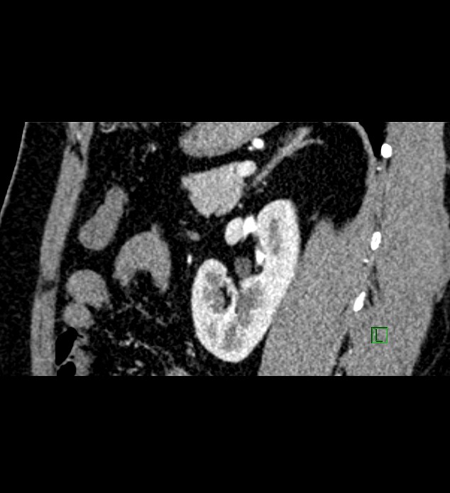Chromophobe renal cell carcinoma (Radiopaedia 84286-99573 F 56).jpg