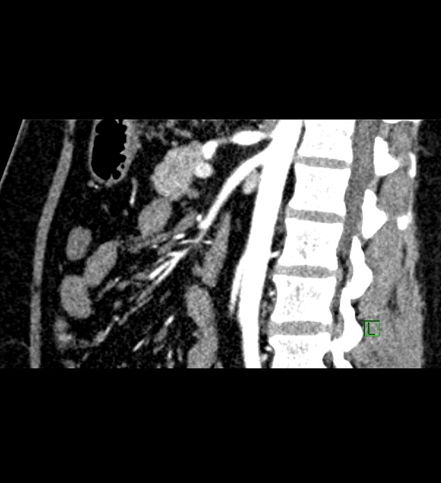 Chromophobe renal cell carcinoma (Radiopaedia 84286-99573 F 78).jpg